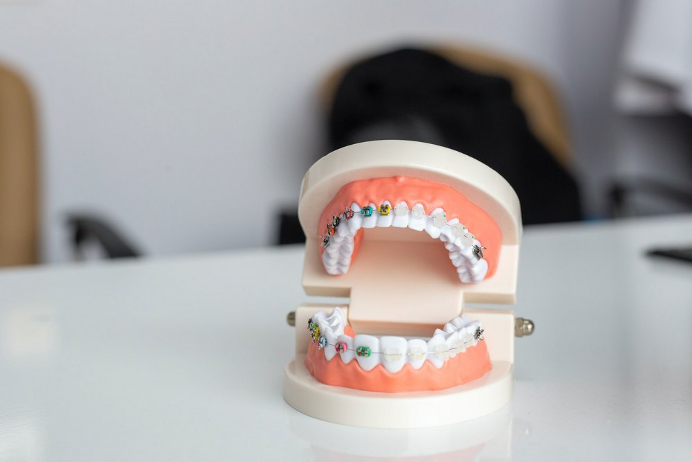 tipuri aparate dentare